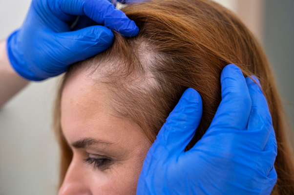 Baldness Treatments