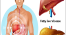 Can Fatty Liver Improve Without Medicine? Lifestyle Changes That May Help